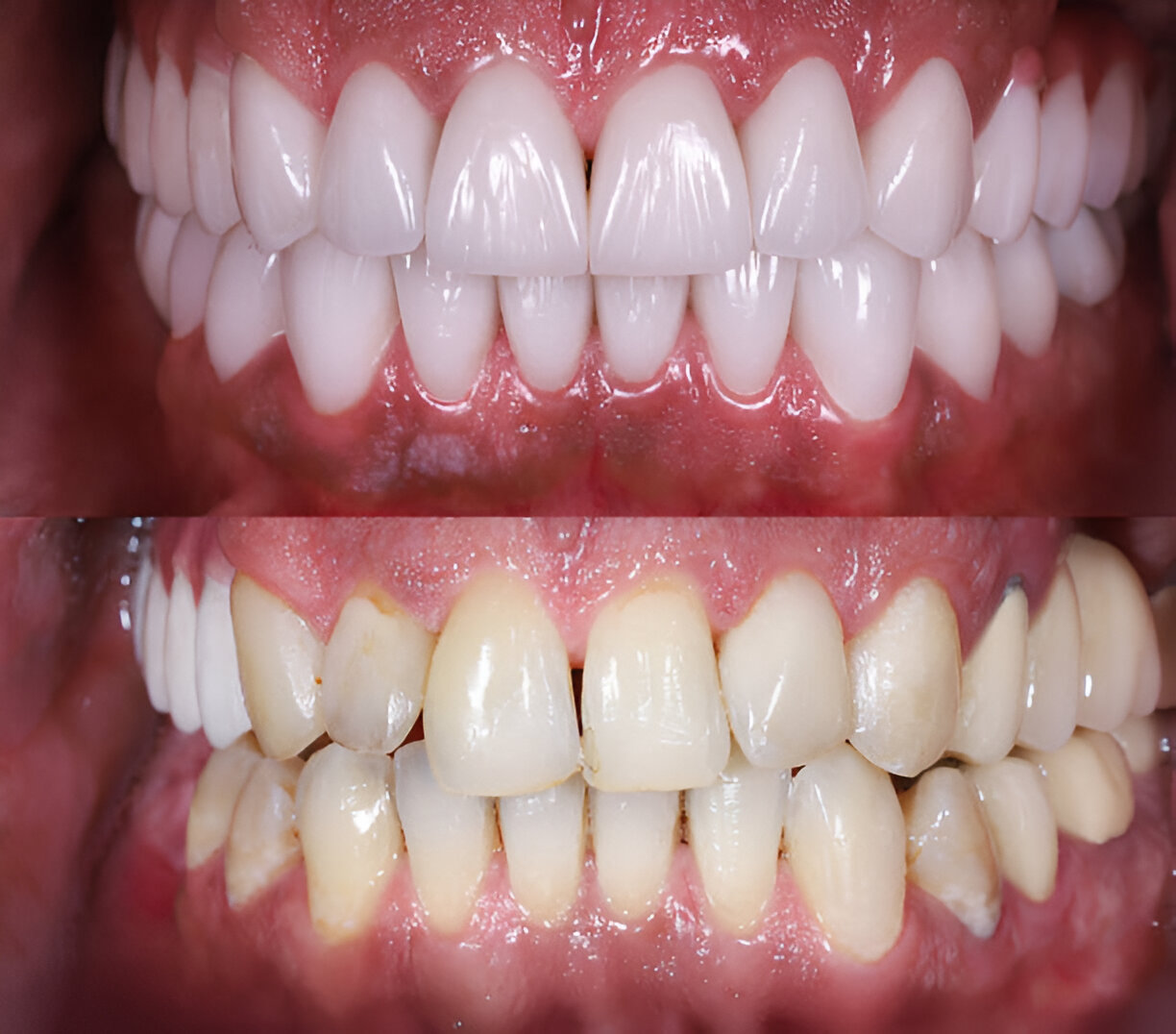 Best Full Mouth Rehabilitation Clinic In Bhayander